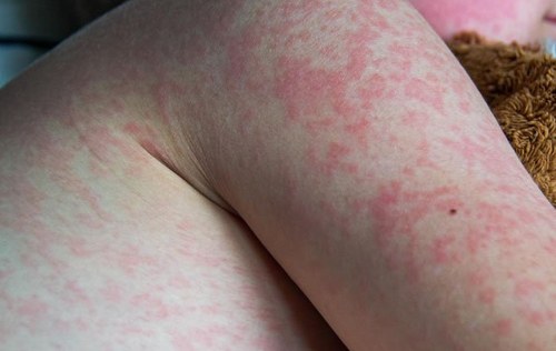 hives on chest
