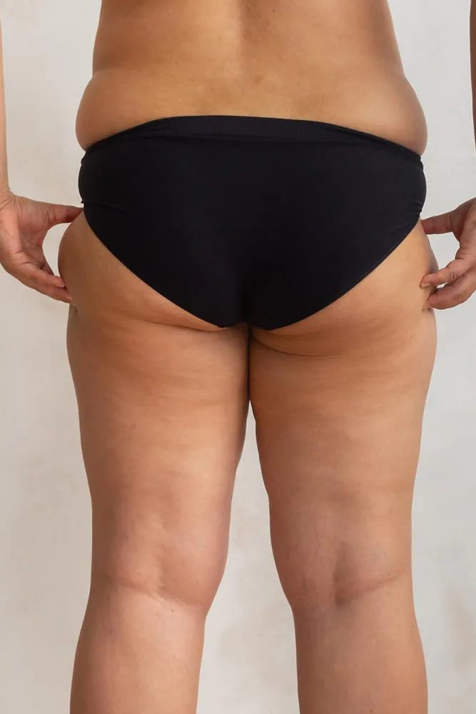 cellulite on thigh before acoustic wave therapy