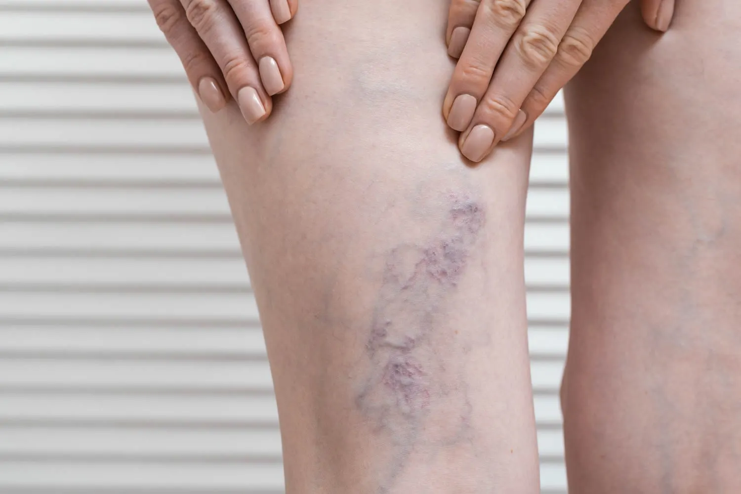 medical dermatology woman leg-with-varicose-veins-varicose-during-pregnancy