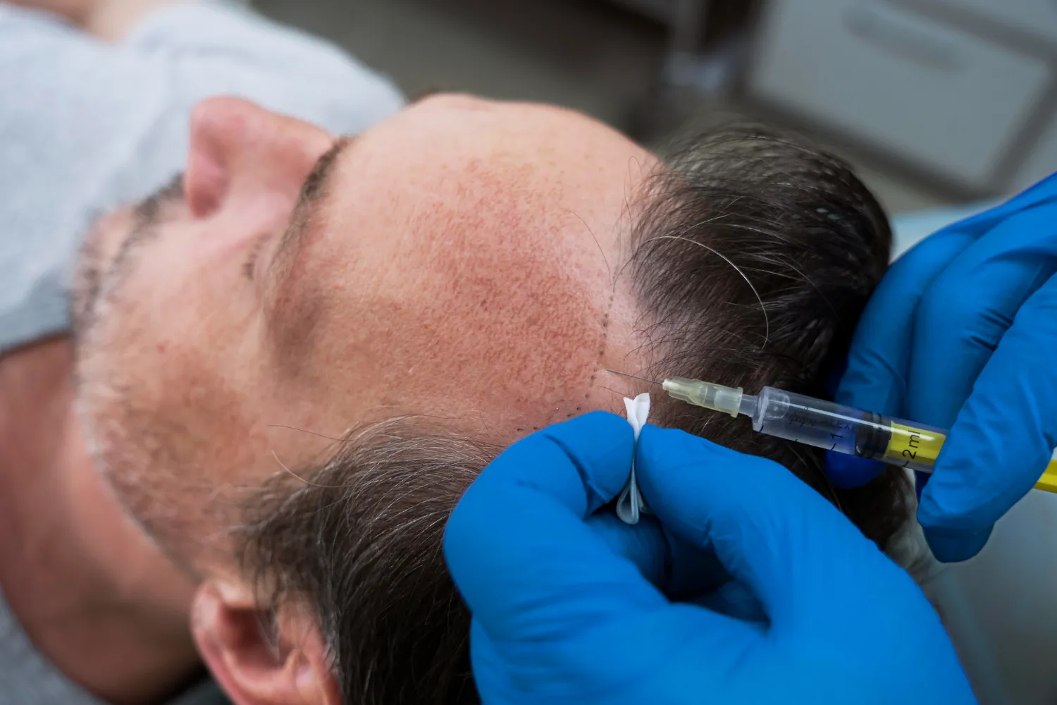 medical dermatology woman man-getting-hair-loss-treatment-prp-dermatology