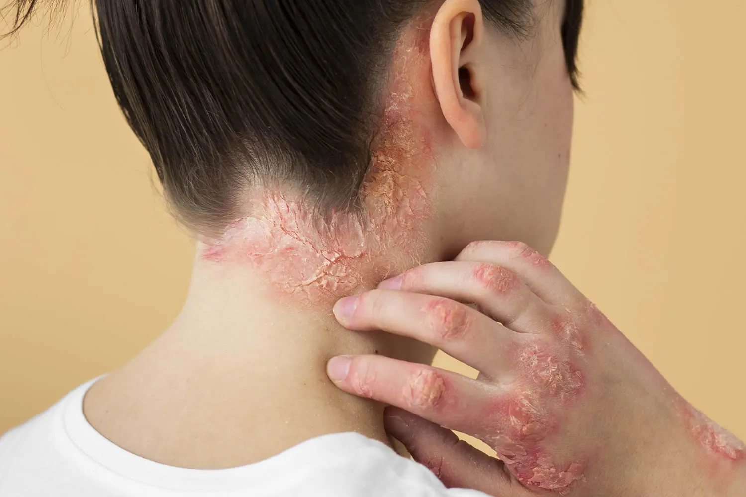 medical dermatology woman psoriasis-eczema-neck-patient