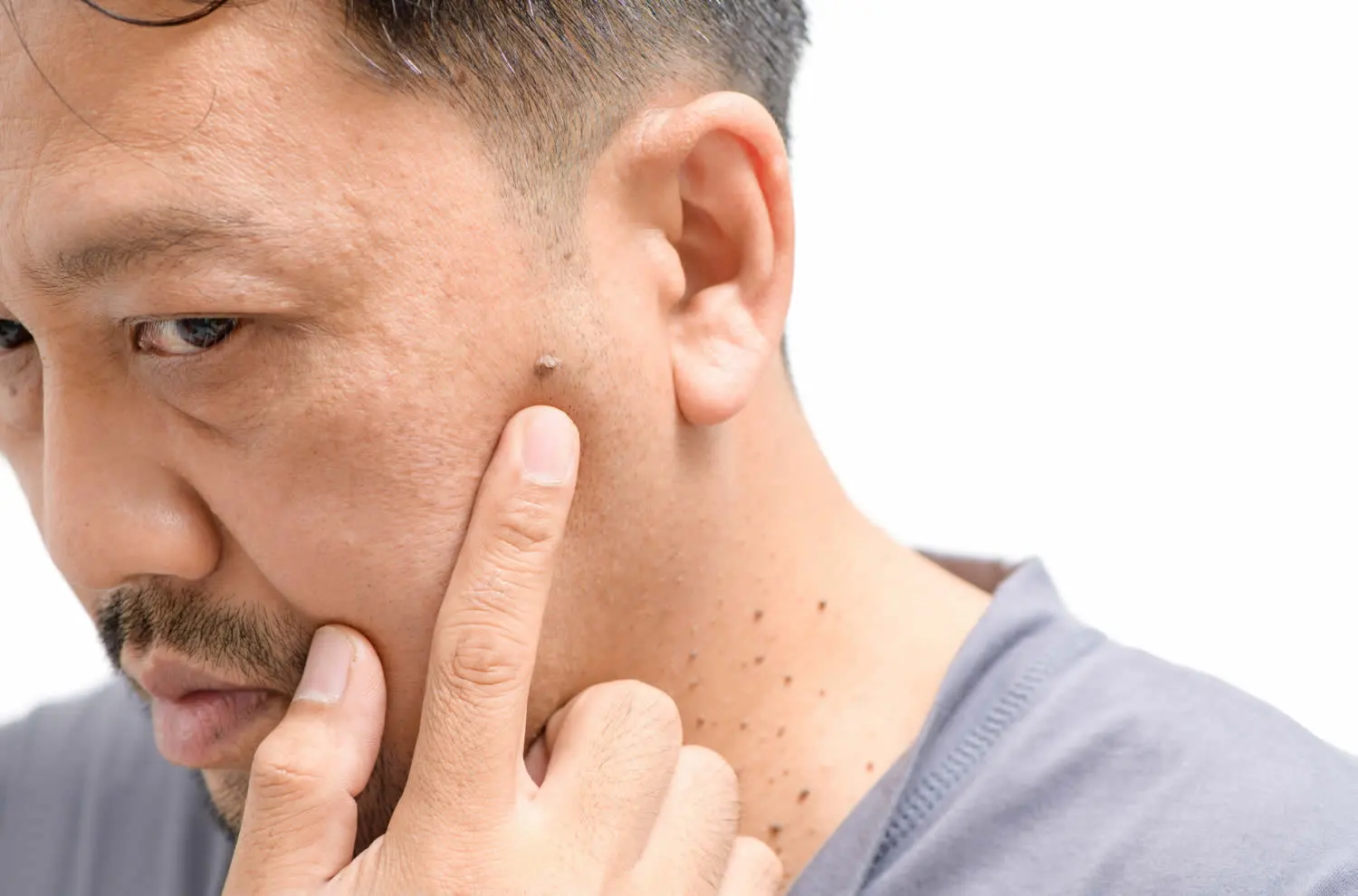 medical dermatology woman big-skin-tags-acrochordon-face