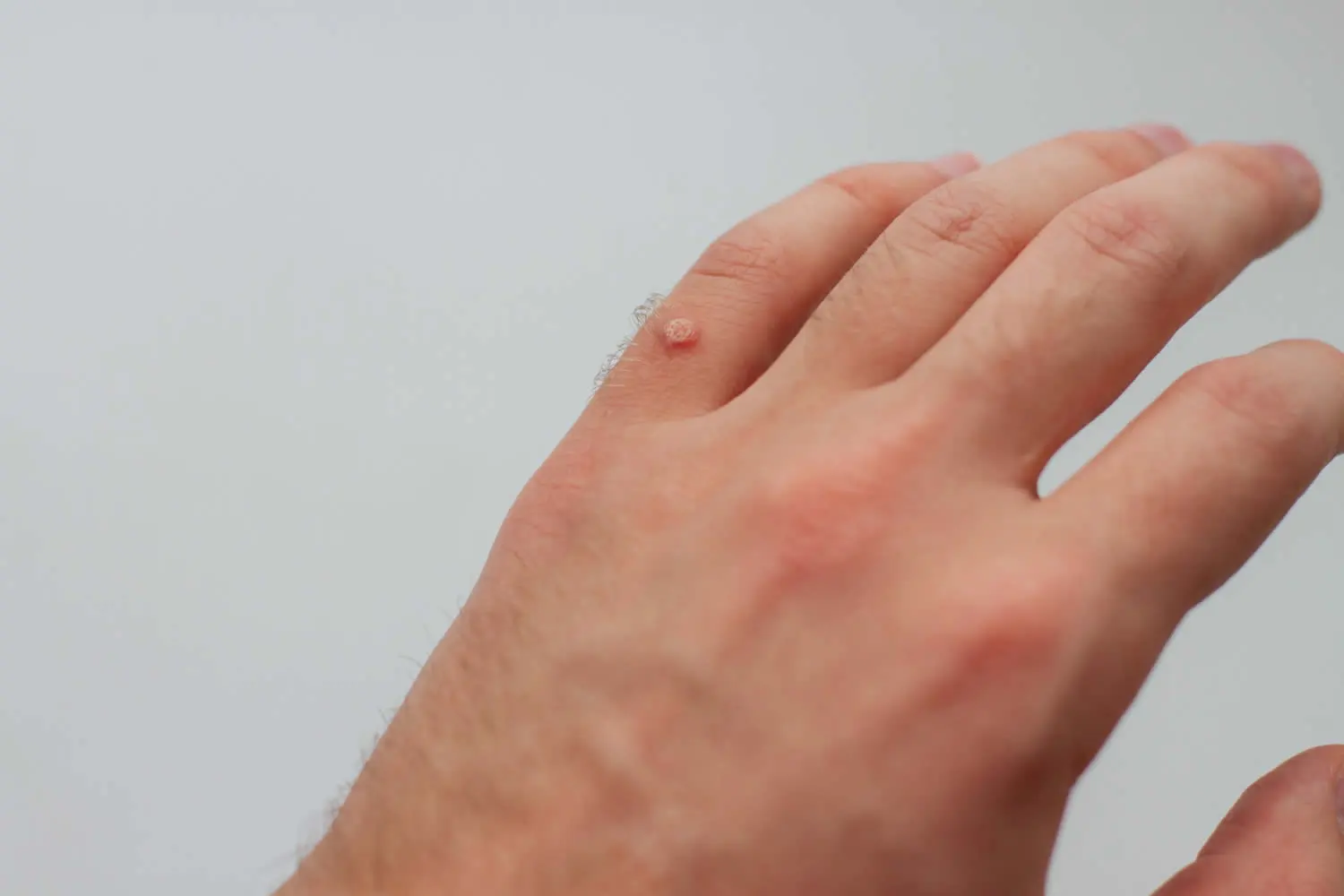 medical dermatology woman wart-hand